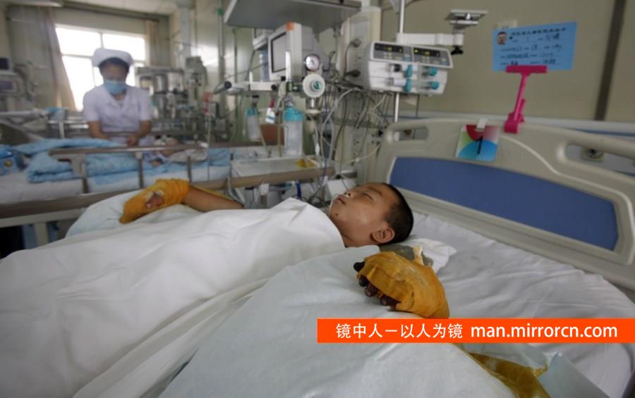 图为2014年06月11日，河北石家庄，孩子在重症监护室里，受伤的手上绑满绷布。