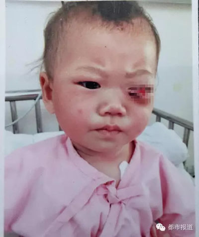 9月大女婴被父亲用筷子戳瞎左眼